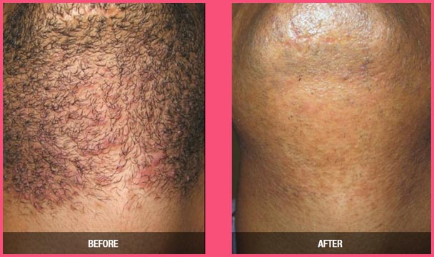 Laser Hair Removal - Before & After